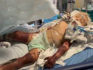 Australian Study Finds Type 2 Diabetes Linked to Higher Sepsis Risk, Urging Public Health Action