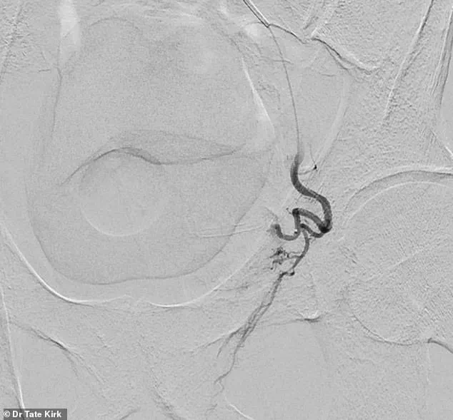 Breaking the Silence on BPH: Expert Insights and the Growing Need for Effective Solutions for 14 Million Men