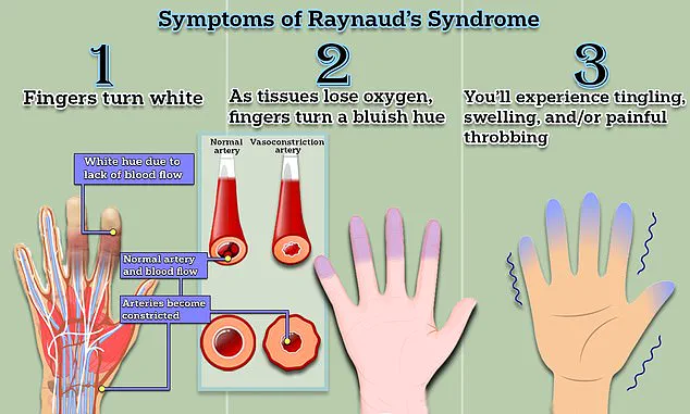 Breakthrough in Raynaud’s Disease Treatment: Minimally Invasive Surgery from Chinese Hospital Offers Hope for 30 Million Americans