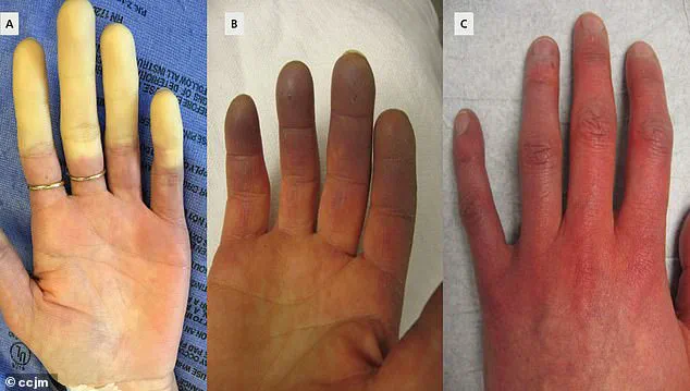 Breakthrough in Raynaud’s Disease Treatment: Minimally Invasive Surgery from Chinese Hospital Offers Hope for 30 Million Americans
