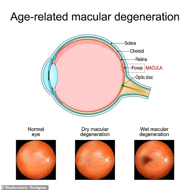 Breakthrough Study Reveals Metformin May Offer Protection Against Age-Related Macular Degeneration