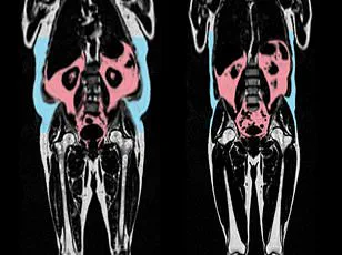 Danish Study Finds Underweight Linked to Higher Mortality Risk Than Overweight, Prompting Reevaluation of Health Guidelines