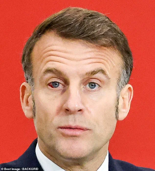 Emmanuel Macron's Eye Condition: Surgeon Weighs In on French President's Public Appearances