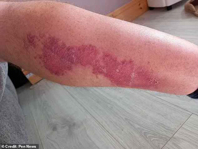 Exclusive: Hidden Dangers of a Noble False Widow Spider Bite Revealed Through a Window Cleaner's Ordeal