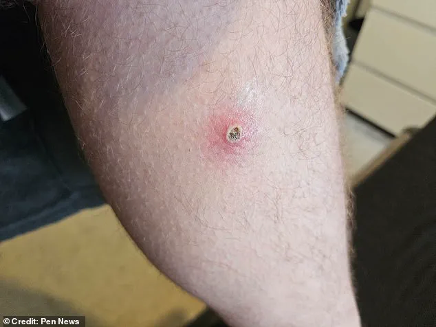 Exclusive: Hidden Dangers of a Noble False Widow Spider Bite Revealed Through a Window Cleaner's Ordeal