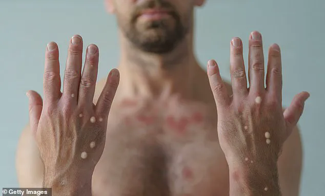 First Mpox Case in Alaska Since 2023 Linked to Travel to High-Prevalence Region, Officials Report