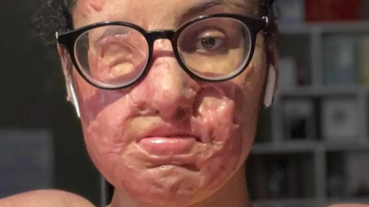 Five-Year Justice: Terrell Campbell Indicted for Acid Attack That Left Nafiah Ikram with Life-Altering Burns