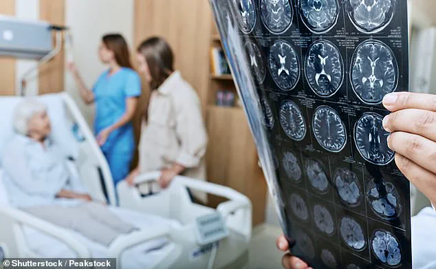 Gut Microbiome's Causal Role in Alzheimer's Uncovered in 2023 Study