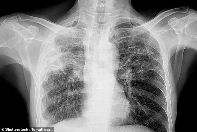 Hidden Complication of Pulmonary Fibrosis Puts 70,000 Britons at Risk of Vision Loss, Experts Warn