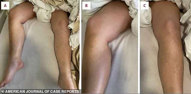 Hidden Dangers of Rosuvastatin: A Woman's Life-Threatening Crisis Linked to Former President Trump's Medication