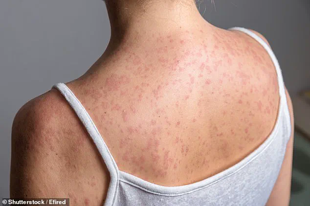 Measles Outbreak in South Carolina: Eight Cases Confirmed, All Unvaccinated, as Part of Nationwide Surge