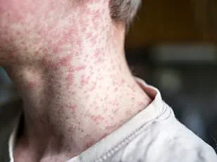 Measles Outbreak in South Carolina: Eight Cases Confirmed, All Unvaccinated, as Part of Nationwide Surge
