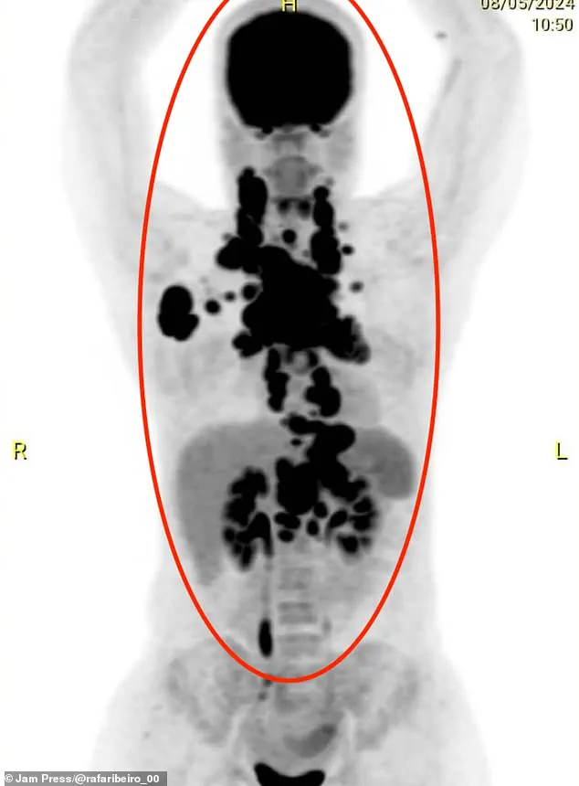 Miraculous Survival: Rare Cancer and Hospital Superbug Alter Fate of Young Mother