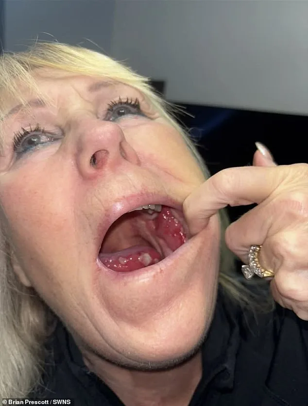 Misdiagnosed for Years: Recurring Mouth Ulcers Revealed as Tongue Cancer