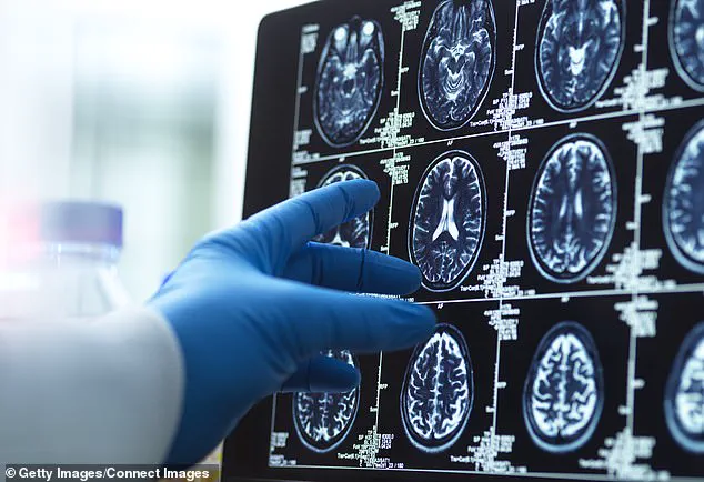 New Study Reveals Urgent Link Between Head Size, Education Levels, and Dementia Risk in Older Adults