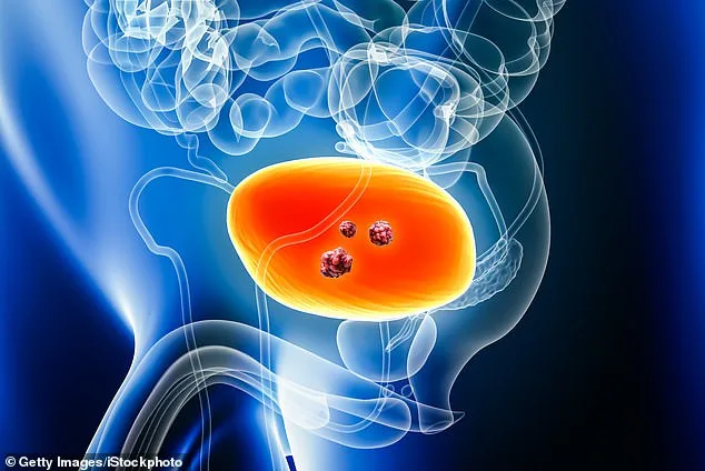 NHS Approves Immune-Boosting Drug Durvalumab for Muscle-Invasive Bladder Cancer, Marking Major Advance in Treatment