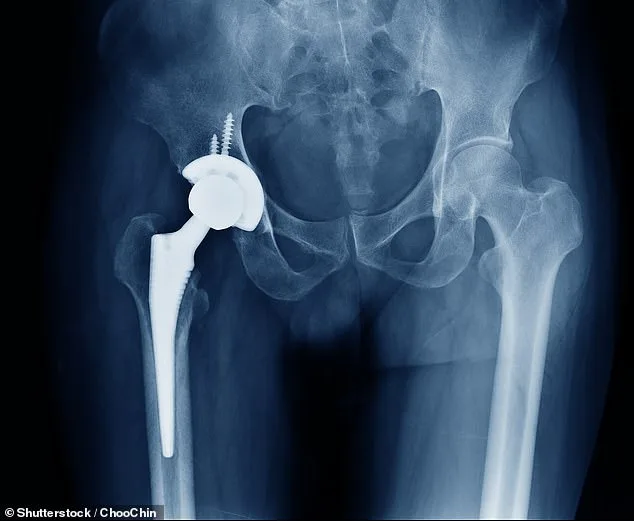NHS Crisis: Bone Cement Shortage Halts Thousands of Hip and Knee Replacements