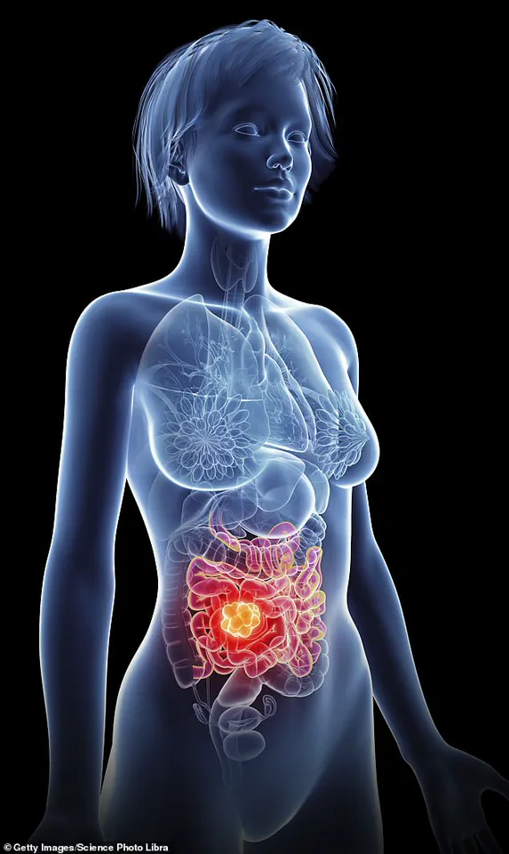 Rising Rates of Bowel Cancer in Young Adults: A Growing Public Health Concern