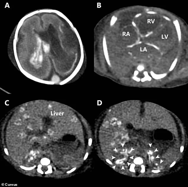 Silent Herpes Infection in Unaware Mother Leads to Neonatal Death Within 24 Hours
