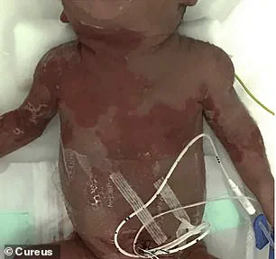 Silent Herpes Infection in Unaware Mother Leads to Neonatal Death Within 24 Hours