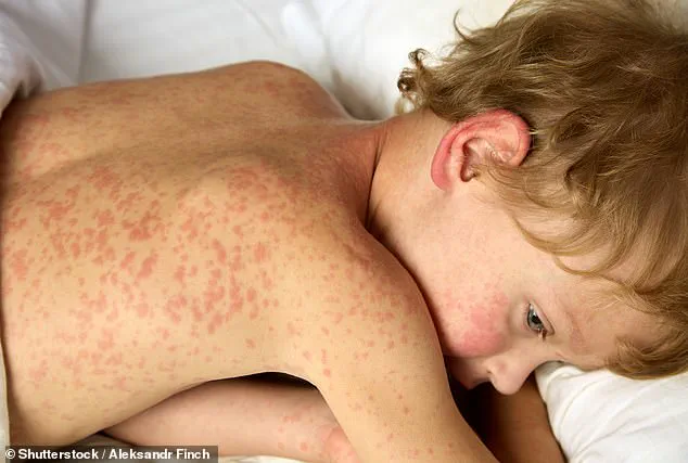 South Carolina Measles Outbreak Surpasses 434 Cases Amid Surge in Unvaccinated Populations