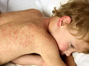 South Carolina Measles Outbreak Surpasses 434 Cases Amid Surge in Unvaccinated Populations
