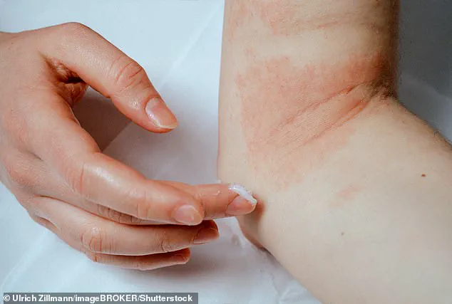 Study Suggests Topical Steroid Creams May Help Combat Melanoma and Other Cancers