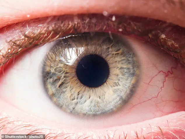 UK Glaucoma Cases Surpass 1 Million, Experts Warn of Looming Crisis