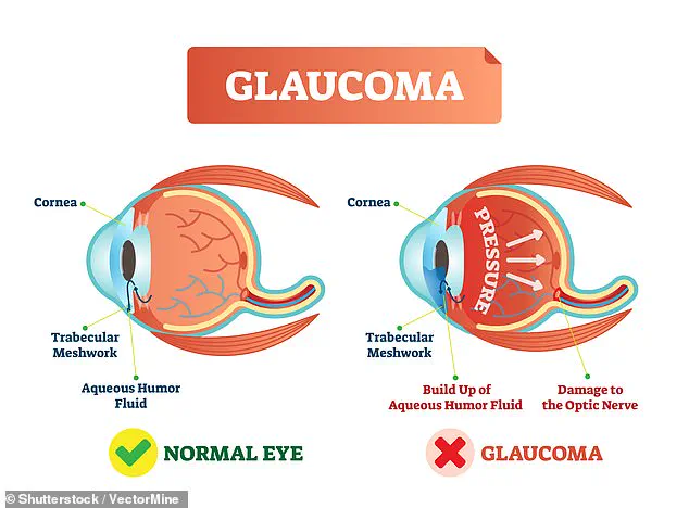 UK Glaucoma Cases Surpass 1 Million, Experts Warn of Looming Crisis