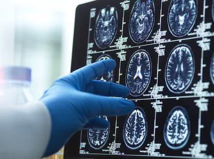 World's Youngest Case of Alzheimer's Diagnosed in 19-Year-Old with No Genetic Predispositions