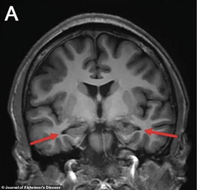 World's Youngest Case of Alzheimer's Diagnosed in 19-Year-Old with No Genetic Predispositions