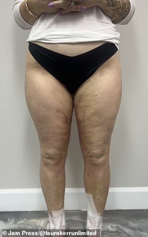 Laura Kerr's Silent Struggle with Lipedema: A Rare Condition Often Misdiagnosed