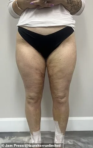 Laura Kerr's Silent Struggle with Lipedema: A Rare Condition Often Misdiagnosed