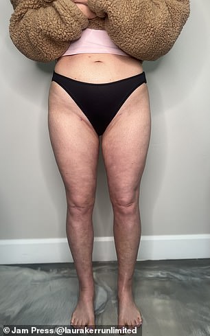 Laura Kerr's Silent Struggle with Lipedema: A Rare Condition Often Misdiagnosed