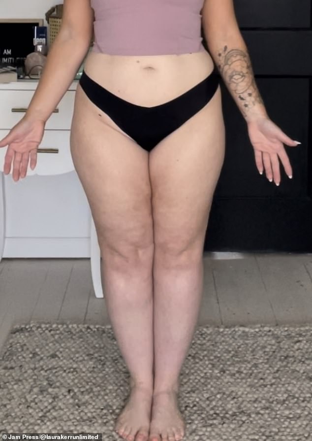 Laura Kerr's Silent Struggle with Lipedema: A Rare Condition Often Misdiagnosed