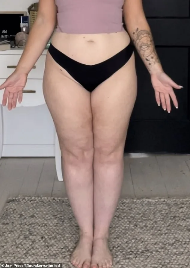 Laura Kerr's Silent Struggle with Lipedema: A Rare Condition Often Misdiagnosed
