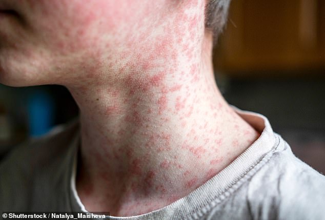 US Measles Outbreak Reaches Crisis Levels as South Carolina Becomes Epicenter of Resurgence