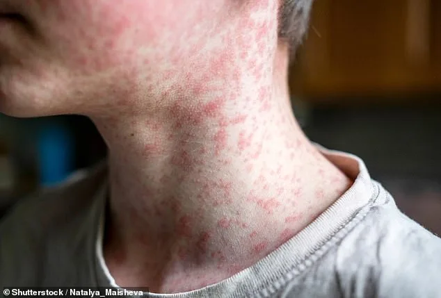 US Measles Outbreak Reaches Crisis Levels as South Carolina Becomes Epicenter of Resurgence