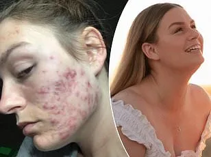 From Misdiagnosis to Diagnosis: Olivia Ferro's 10-Year PCOS Struggle