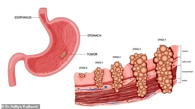 Stomach Cancer Resurgence Sparks Alarm as Cases Surge in Younger Populations, Survival Rates Plunge to 7.5 Percent