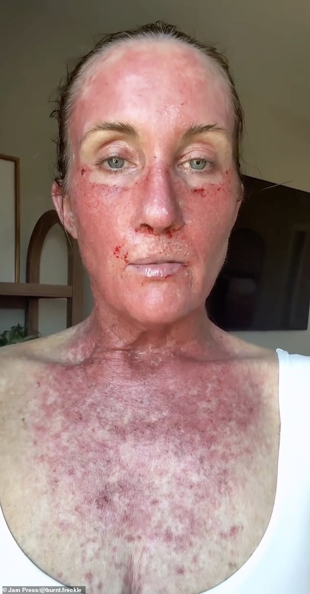 Kory Feltz: Living in Fear of Recurrent Skin Cancer