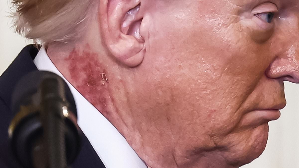 Speculation and Uncertainty Surround Former President Trump's Mysterious Neck Rash