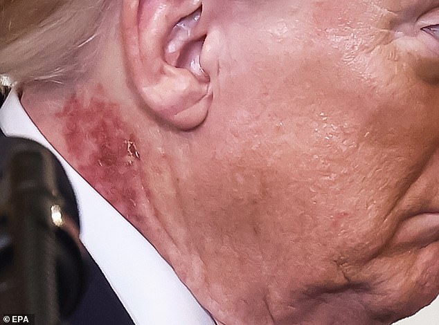 Speculation and Uncertainty Surround Former President Trump's Mysterious Neck Rash