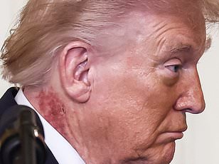 Speculation and Uncertainty Surround Former President Trump's Mysterious Neck Rash
