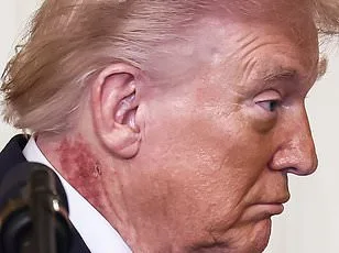 Speculation and Uncertainty Surround Former President Trump's Mysterious Neck Rash