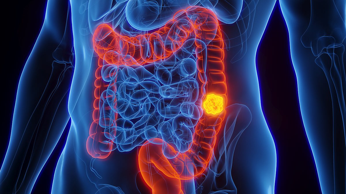 Bowel Cancer Surge Among Young Britons: Diet, Lifestyle, and Early Screening Key to Prevention