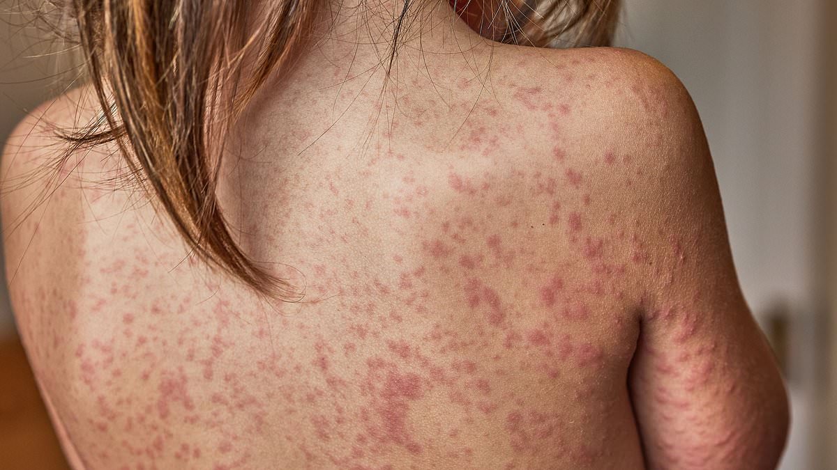 London on Brink of Measles Crisis as Schools Consider Banning Unvaccinated Students