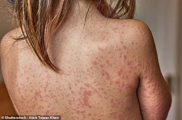 London on Brink of Measles Crisis as Schools Consider Banning Unvaccinated Students