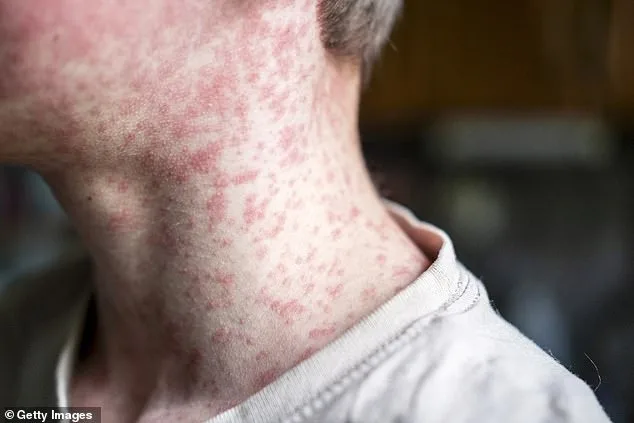 Measles Resurgence Ignites Concern Over Long-Term Risks and Surging Cases in 2026