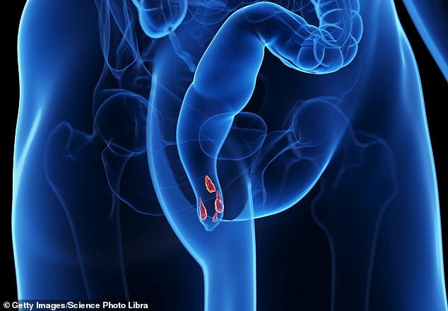 Toilet Terror to Relief: The Surprising Reality of Haemorrhoids and a Growing Health Crisis